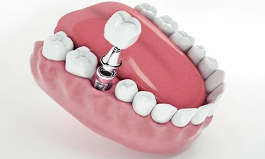 implant-dental-treatment