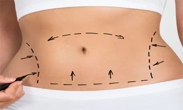 Abdominoplasty (Abdominal Lift)