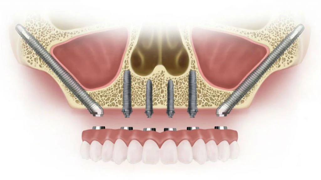 zygoma-implant